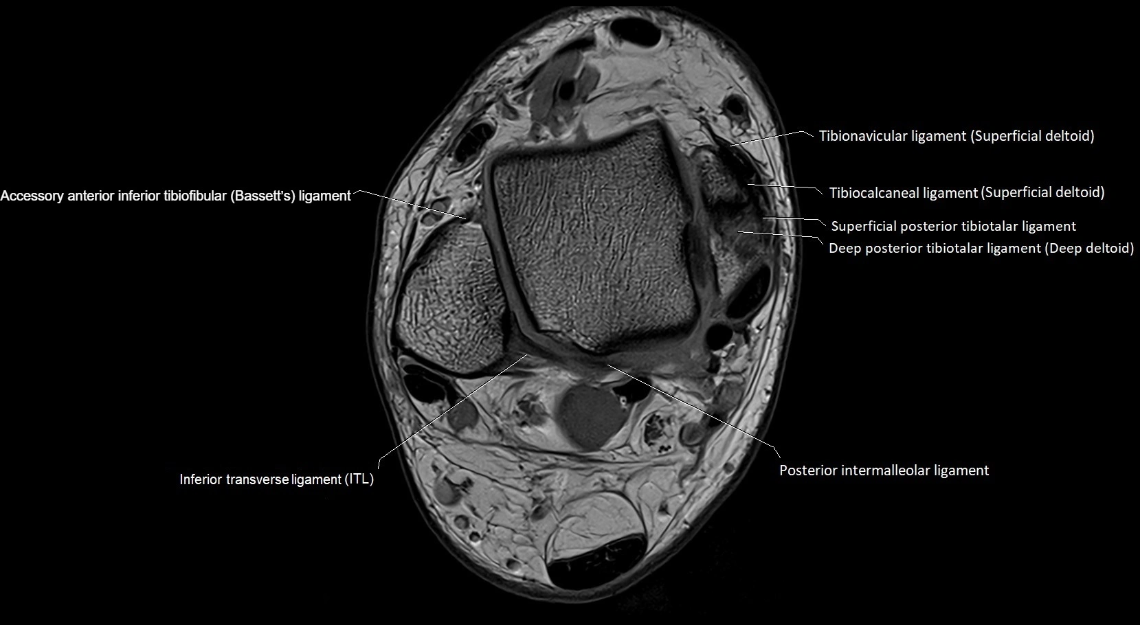 MRI ankle ligaments anatomy axial 3T image 6.webp